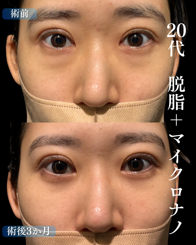 20代女性　脱脂+脂肪注入